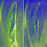 photo collage showing effects of labiaplasty case #1641 photo1