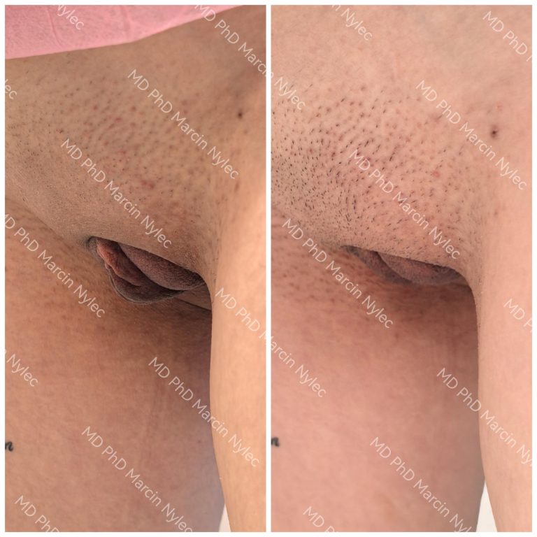 Labiaplasty before and after, case #1002